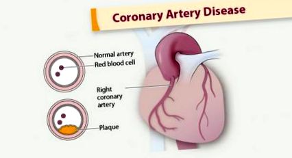 коронарна артериална