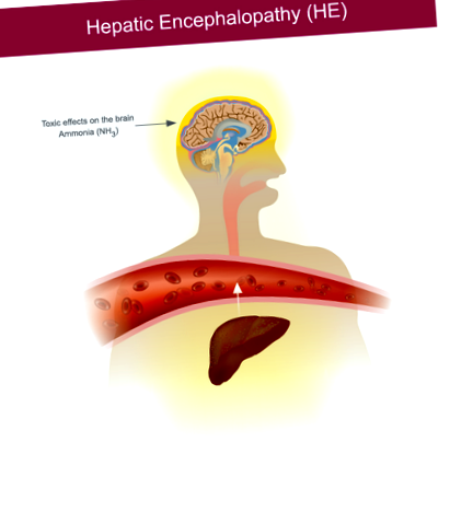 Encefalopatie hepatică