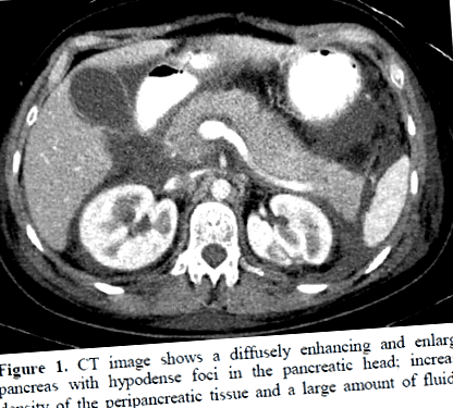 pancreatita