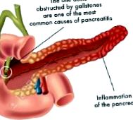 pancreatită