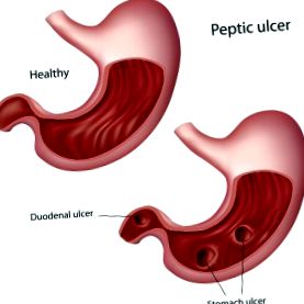 peptic