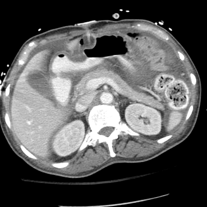 gastrostomia