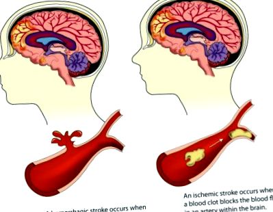 accident vascular cerebral