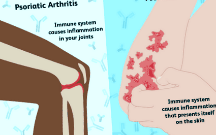 артрит