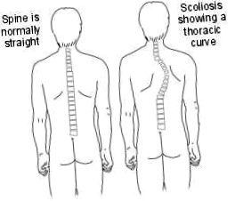 сколиоза