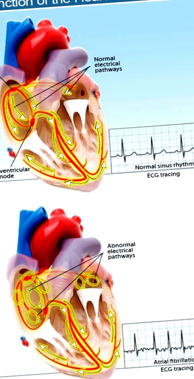 atrial