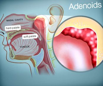 adenoiditei