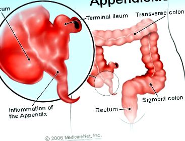 apendicită