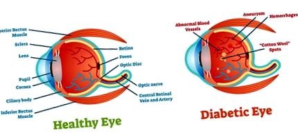 retinopatiei diabetice