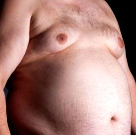 гинекомастията затлъстяването