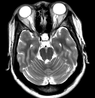 intracraniană