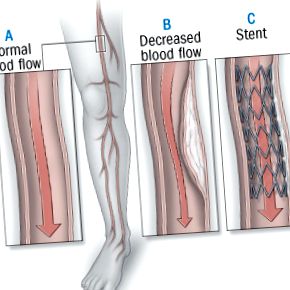 periferice