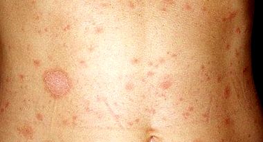 pityriasis