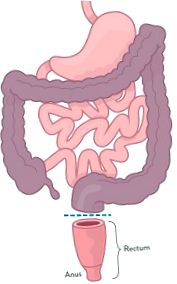 proctocolectomie