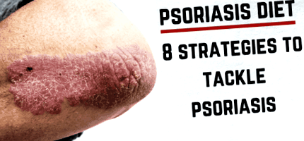 psoriazisul