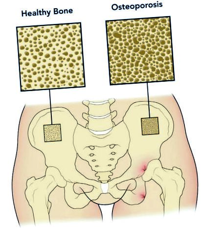 vitamina calciu