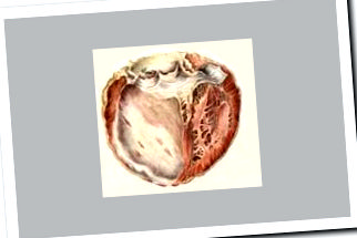 cardioscleroza