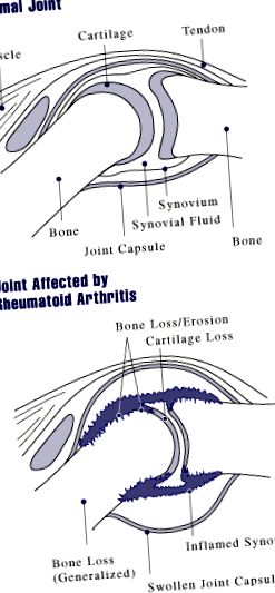 ревматоиден артрит