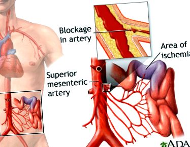 ischemia