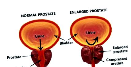 prostată