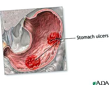 stomacului