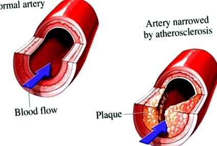 arterei