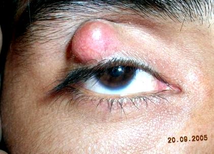 chalazion