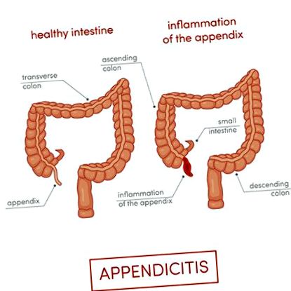 апендектомия