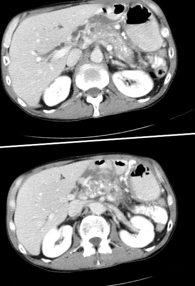 pancreatogen