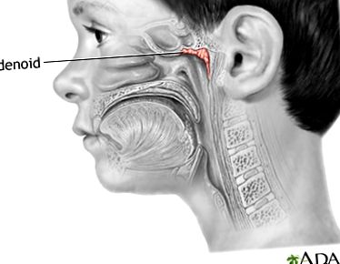 adenoide