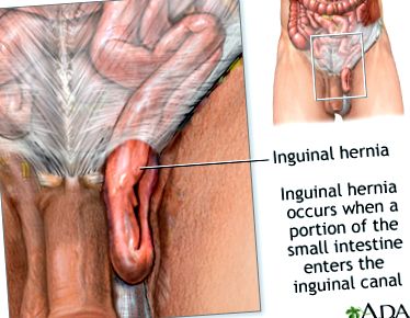 hernia