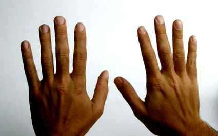 Obezitatea legată de osteoartrita la nivelul mâinilor