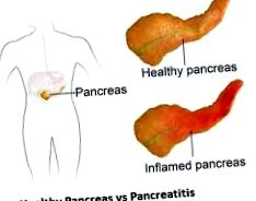 хроничен панкреатит