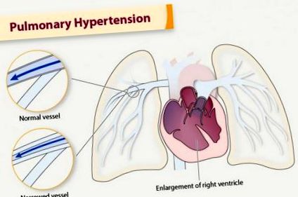 hipertensiunea pulmonară