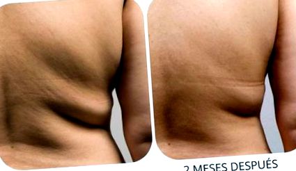 coolsculpting