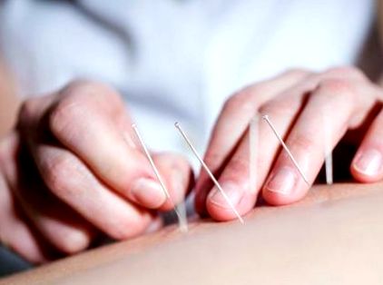 acupunctura