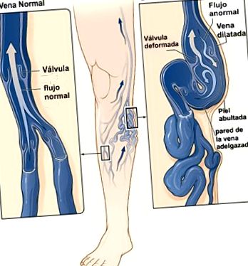 Primele semne și simptome ale varicelor pe picioare: ce trebuie să faci?