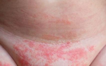Dermatomiozita: Cauze, manifestari si tratament - Sensiblu