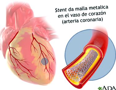 szív-egészségügyi angioplasztika