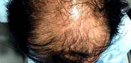 alopeciát