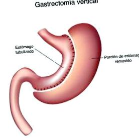 gastrectomie