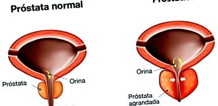 neoplasia de prostata maligna prostatita cum se expune