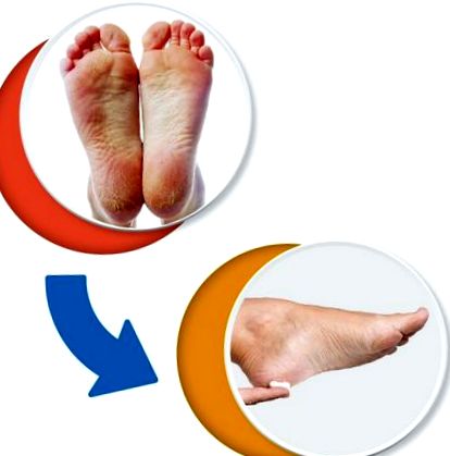 A lábujjak közötti sebek kezelése