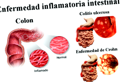 inflamatorie