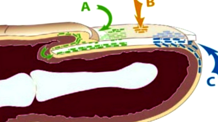 onychomycosis