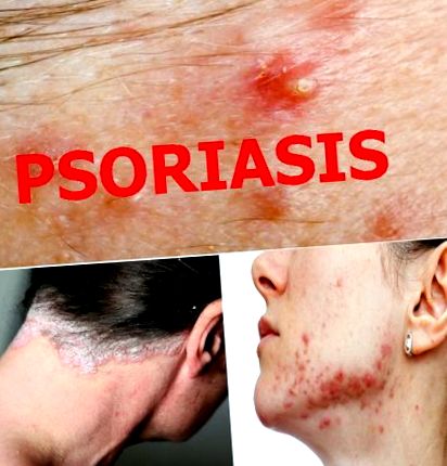A sík psoriasis: okai és kezelése