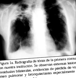 pulmonară