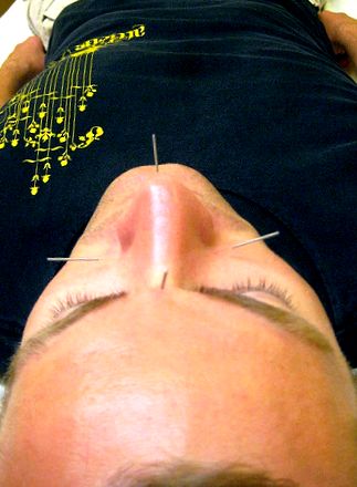 akupunktúra