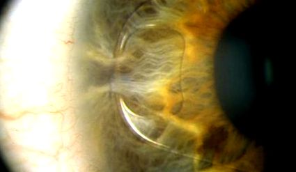 рефракційна допомогою