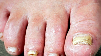 gombák a körmök kezeléseknél a körömgomba és a lábak kezelése